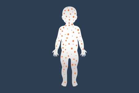 Measles logo icon design, vector illustration baby with dots on body